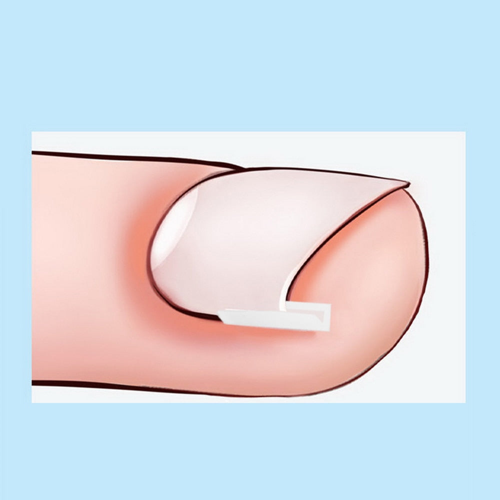 Ingrown Nail Pad Set Filling Groove Pad Toenail Corrector